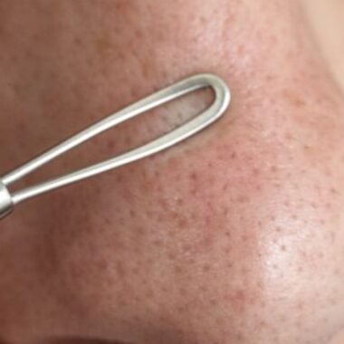 طريقة ازالة الرؤس السوداء طبيعيا في اقل وقت.. تعرفي عليها